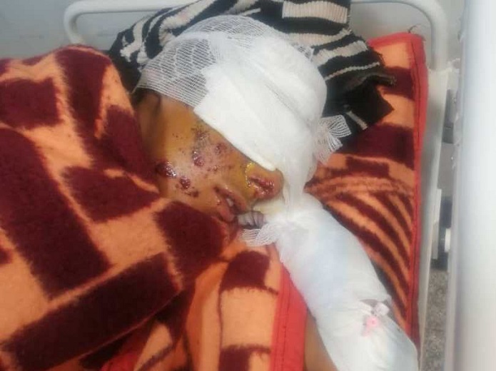 وضعیت وخیم نوجوانان قربانی انفجار مین وضعیت وخیم نوجوانان قربانی انفجار مین