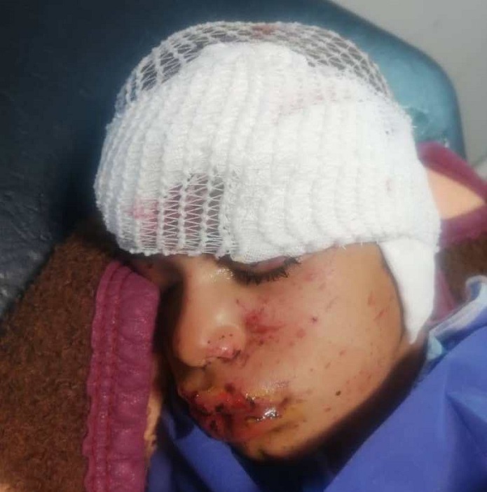 وضعیت وخیم نوجوانان قربانی انفجار مین وضعیت وخیم نوجوانان قربانی انفجار مین