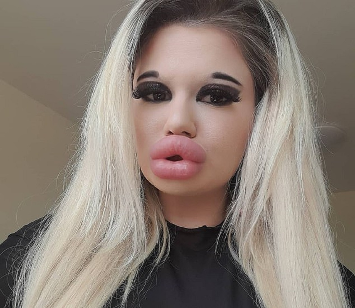 دختری که بزرگترین لبهای دنیا را دارد! + تصاویر دختری که بزرگترین لبهای دنیا را دارد! + تصاویر