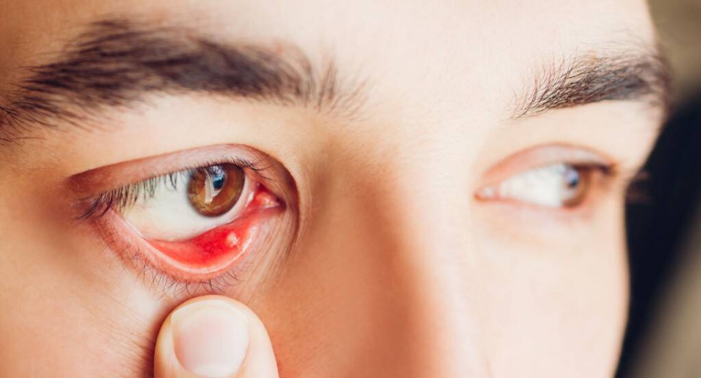 درمان گل مژه درمان گل مژه