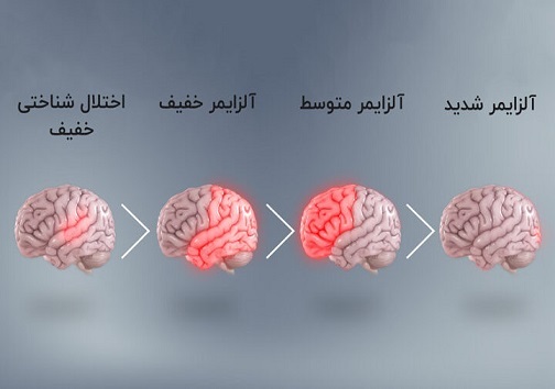 مواد غذایی موثر برای مقابله و پیشگیری از آلزایمر
