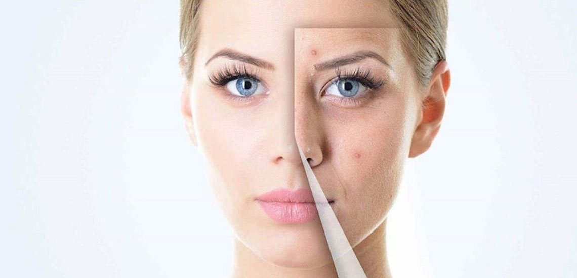 جوش صورت جوش صورت