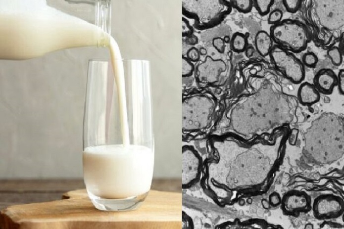 تشدید علائم بیماری اماس با مصرف لبنیات لبنیات