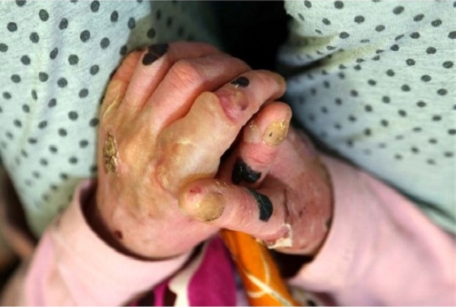 بیماران پروانهای بیماران پروانهای