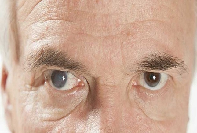 از آب سیاه چشم بیماری «دزد بی صدا» چه میدانیم از آب سیاه چشم بیماری «دزد بی صدا» چه میدانیم