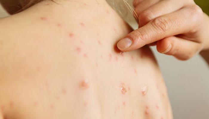 سرخک؛ مسریترین بیماری عفونی است/ واکسیناسیون کودکان را به تاخیر نیندازید سرخک