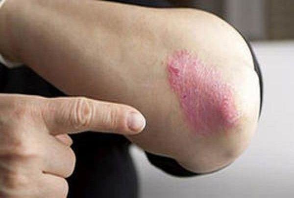 پسوریازیس پسوریازیس