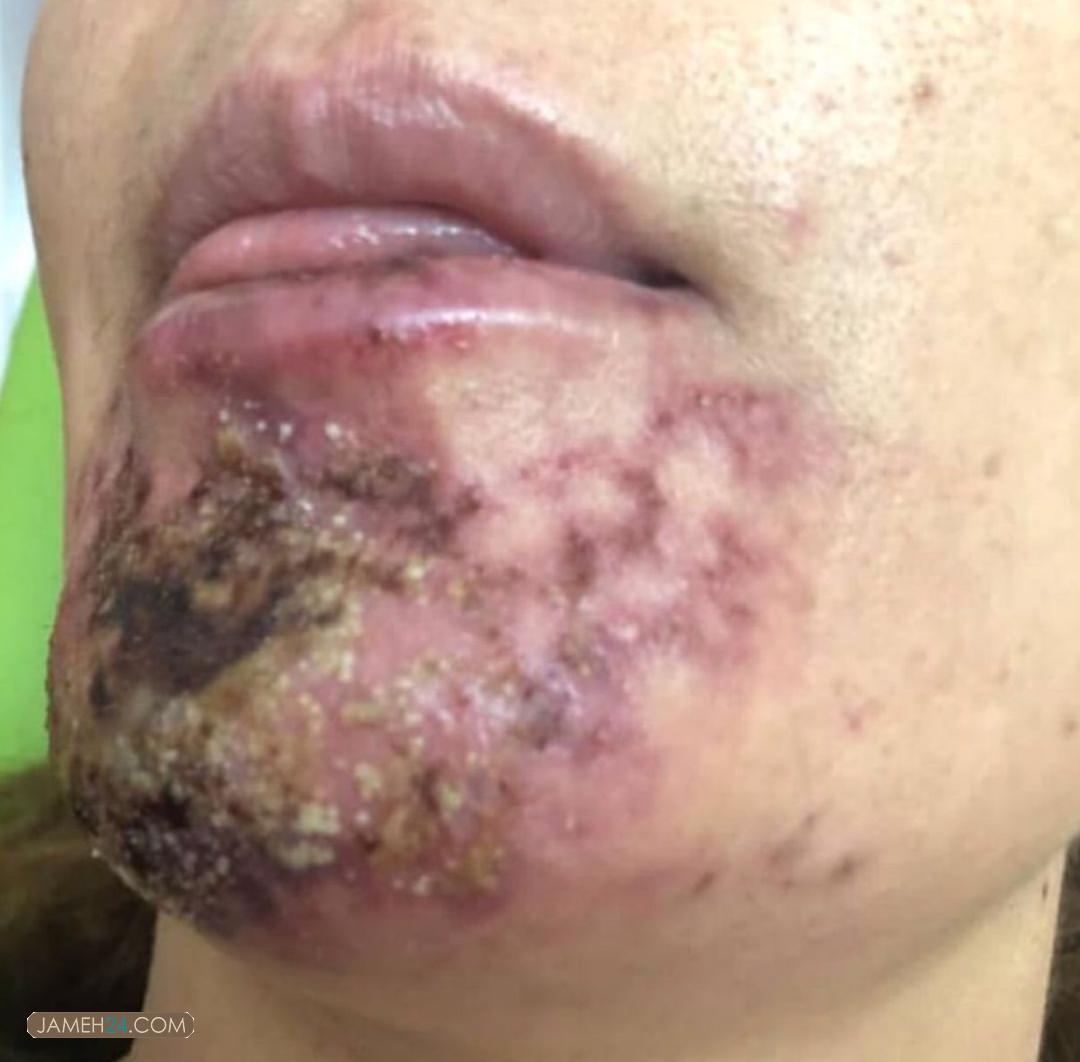 چگونه پزشکان عمومی پولدار میشوند؟ / پشت پرده تبلیغات گسترده پوست و مو/از ورود به حوزه تخصصی زیبایی تا آسیب رساندن به سلامت بیماران چگونه پزشکان عمومی پولدار میشوند؟ / پشت پرده تبلیغات گسترده پوست و مو/از ورود به حوزه تخصصی زیبایی تا آسیب رساندن به سلامت بیماران