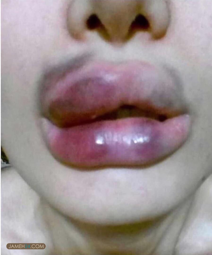 چگونه پزشکان عمومی پولدار میشوند؟ / پشت پرده تبلیغات گسترده پوست و مو/از ورود به حوزه تخصصی زیبایی تا آسیب رساندن به سلامت بیماران چگونه پزشکان عمومی پولدار میشوند؟ / پشت پرده تبلیغات گسترده پوست و مو/از ورود به حوزه تخصصی زیبایی تا آسیب رساندن به سلامت بیماران