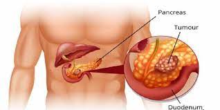 سرطان پانکراس 