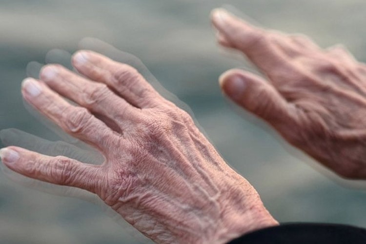 شایعترین علل ابتلا به یک اختلال عصبی پیشرونده پارکینسون