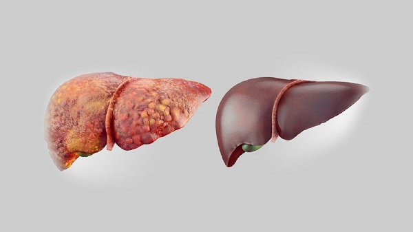 راهکارهایی برای پیشگیری از ابتلا به کبد چرب راهکارهایی برای پیشگیری از ابتلا به کبد چرب