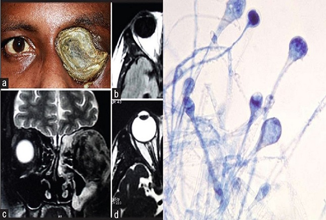 قارچ سیاه قارچ سیاه