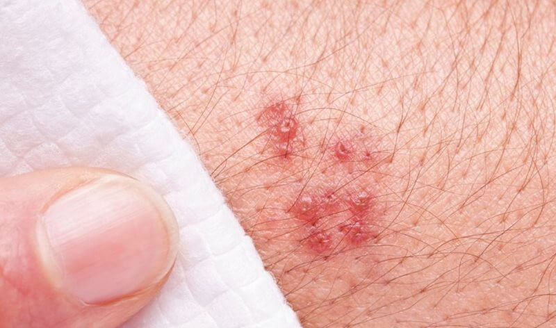 تبخال تناسلی 