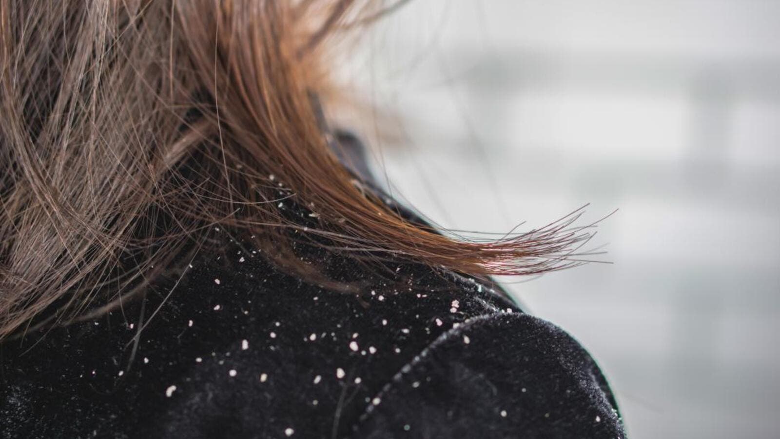 درمان شوره سر درمان شوره سر