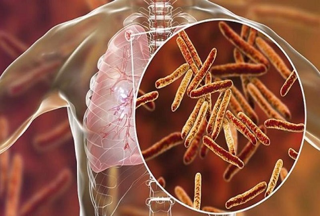 افزایش ابتلا و مرگ ناشی از سل در پاندمی کرونا