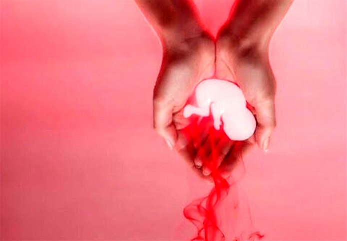 انجام روزانه ۱۳۰۰ سقط جنین غیرقانونی در ایران سقط جنین