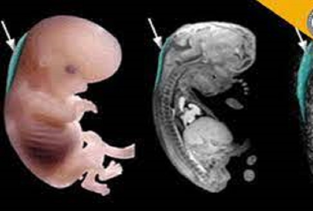 داروی جلوگیری از سقط جنین و سرطان داروی جلوگیری از سقط جنین و سرطان