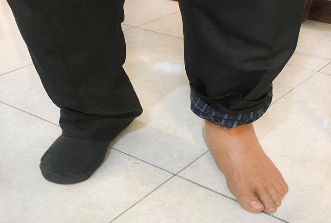 دستگیری دزدی که با پای مصنوعی موبایل قاپی می کرد دستگیری دزد یک پا