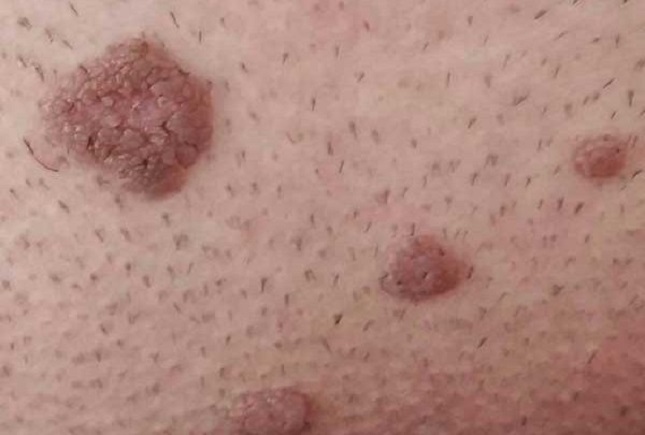 زگیل و تبخال تناسلی زگیل و تبخال تناسلی