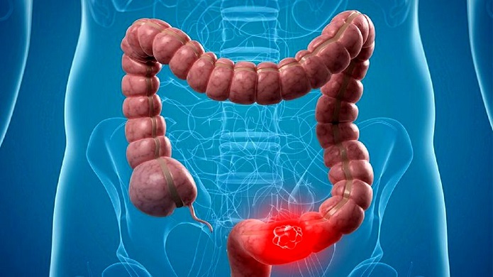 ارتباط عجیب میان سرطان روده و افسردگی سرطان روده