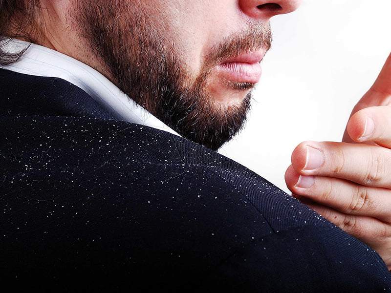 شوره سر شوره سر