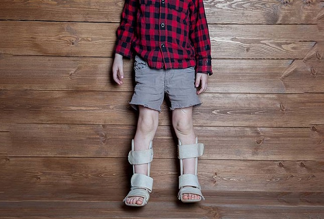 راشیتیسم و پوکی استخوان در کمین کودکان کم تحرک راشیتیسم و پوکی استخوان در کمین کودکان کم تحرک