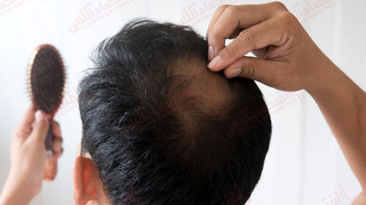 ریزش مو ریزش مو