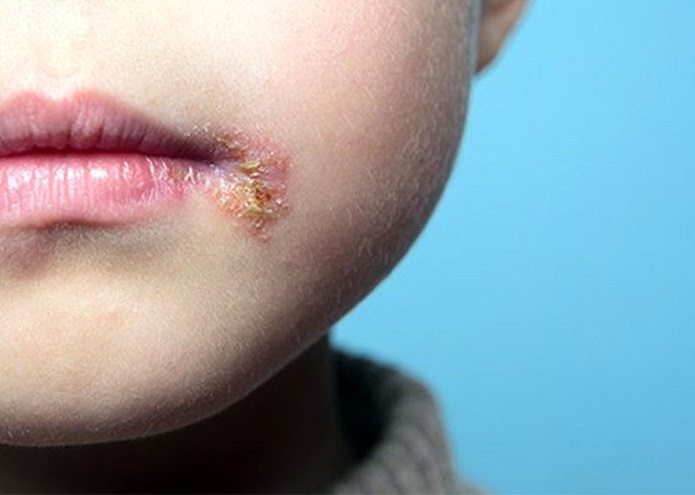 کشفی تازه در دانشگاه قزوین تبخال