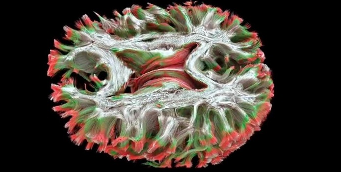  بیماری ام اس