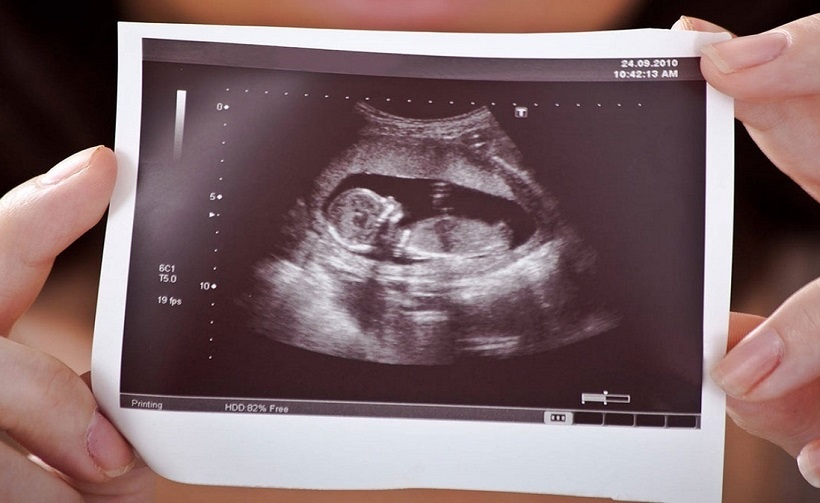 تبعات حذف غربالگری جنین در جامعه تبعات حذف غربالگری جنین در جامعه