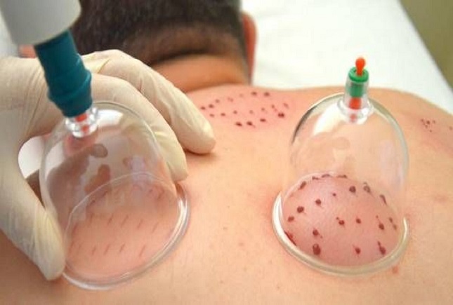 بهترین زمان برای «حجامت» کی است؟ بهترین زمان برای «حجامت» کی است؟