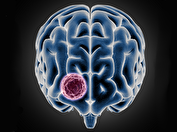 نشانه‌های هشداردهنده تومور مغزی