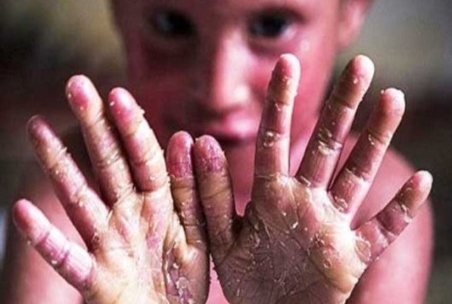 حدود ۸۰۰ بیمار پروانهای در کشور زندگی میکنند حدود ۸۰۰ بیمار پروانهای در کشور زندگی میکنند