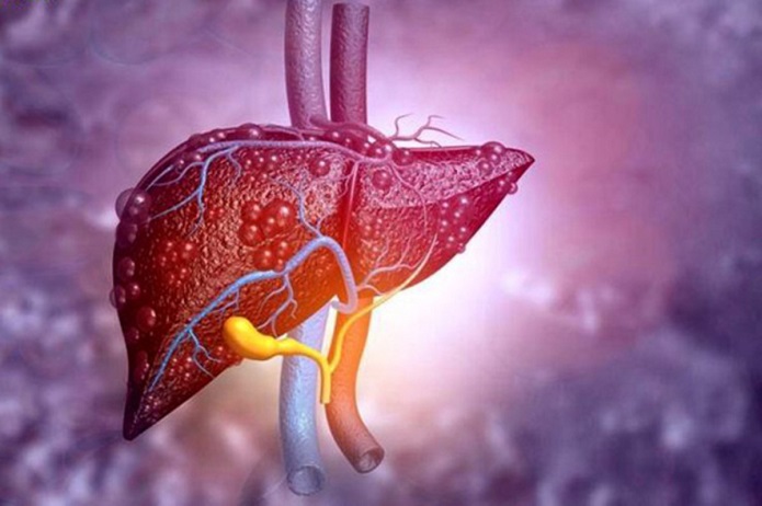 مهمترین علائم کبد چرب را بشناسید کبد چرب