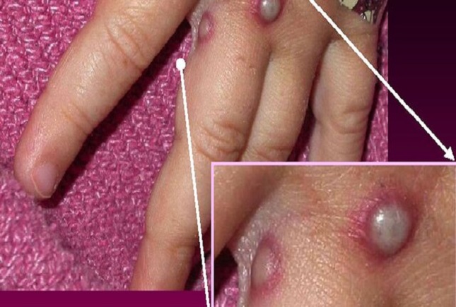 بررسی موارد ابتلا به آبله میمون در جهان بررسی موارد ابتلا به آبله میمون در جهان