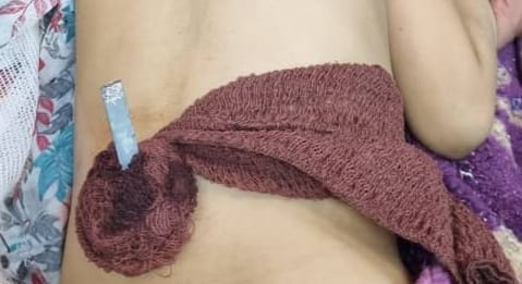 گیر کردن سیخ کباب در بدن