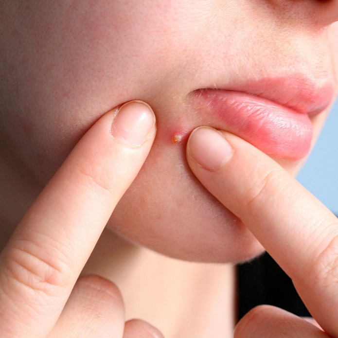 روشهایی برای رفع جوش صورت روشهایی برای رفع جوش صورت