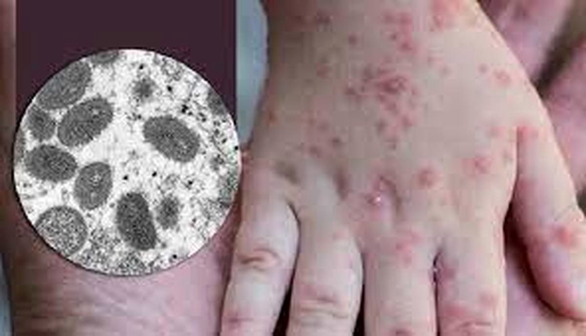 آبله میمونی