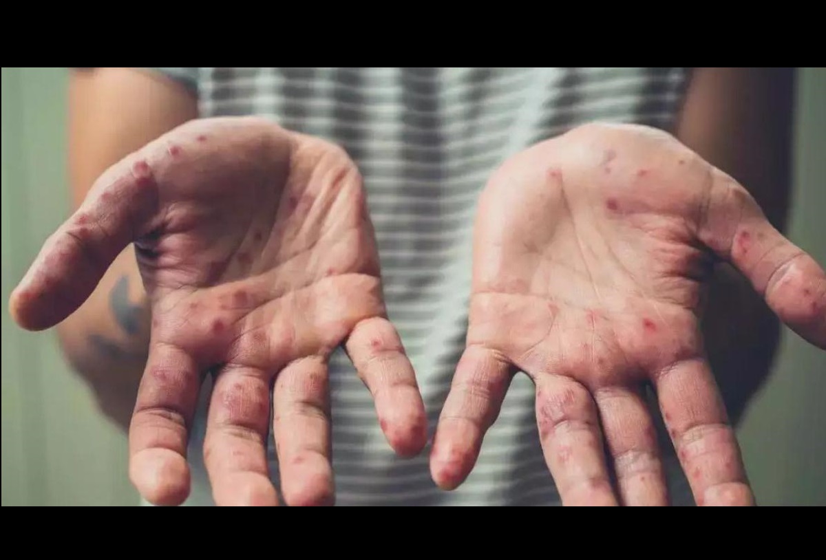 پیشگیری از آبله میمون پیشگیری از آبله میمون