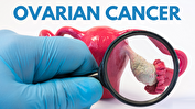 علائم ابتلا به سرطان تخمدان چیست؟