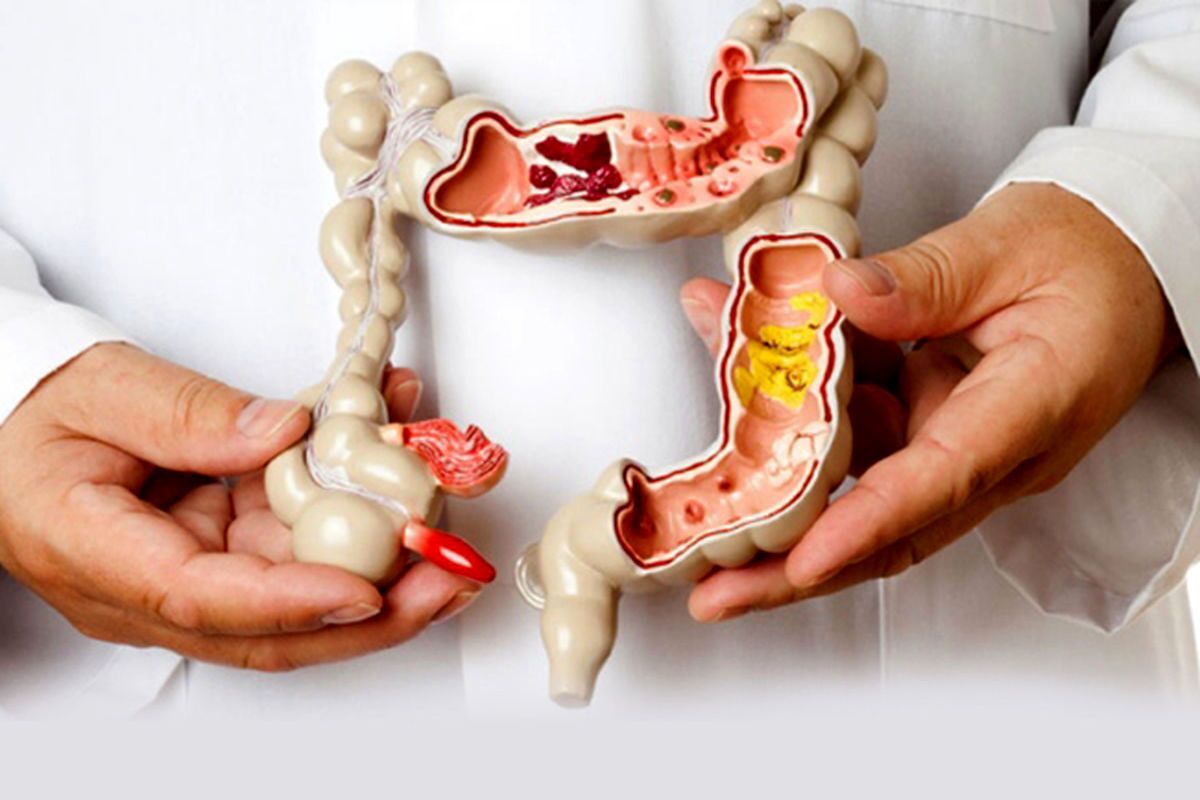 علائم اولیه سرطان روده بزرگ چیست؟