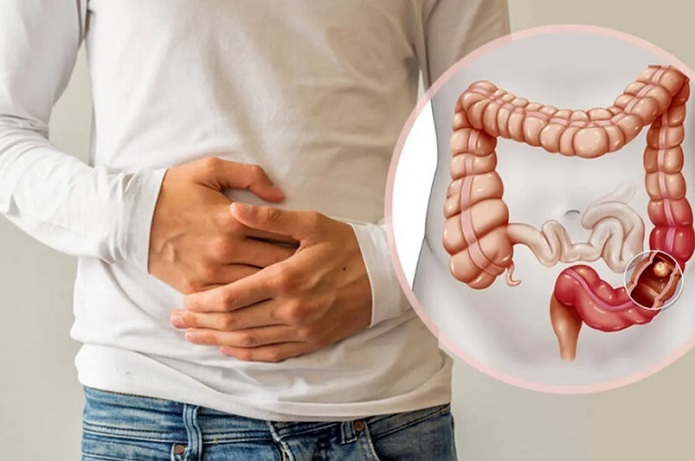 علائم اولیه سرطان روده بزرگ چیست؟