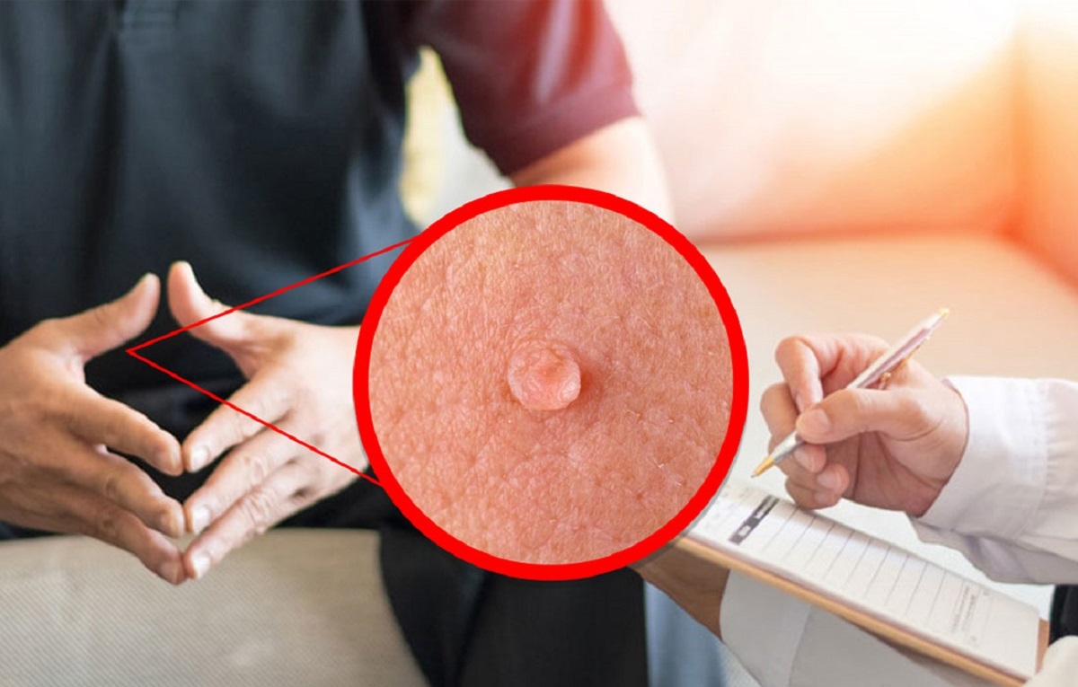 علائم ابتلا به سرطان آلت تناسلی چیست؟