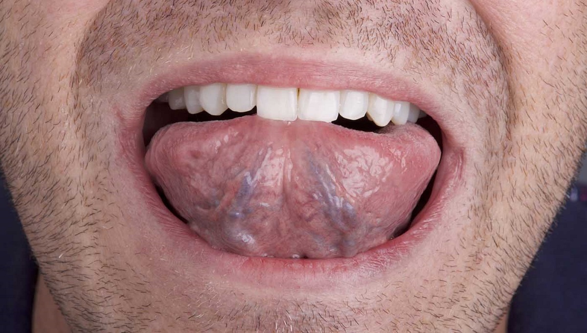 علائم ابتلا به سرطان زبان کدامند؟