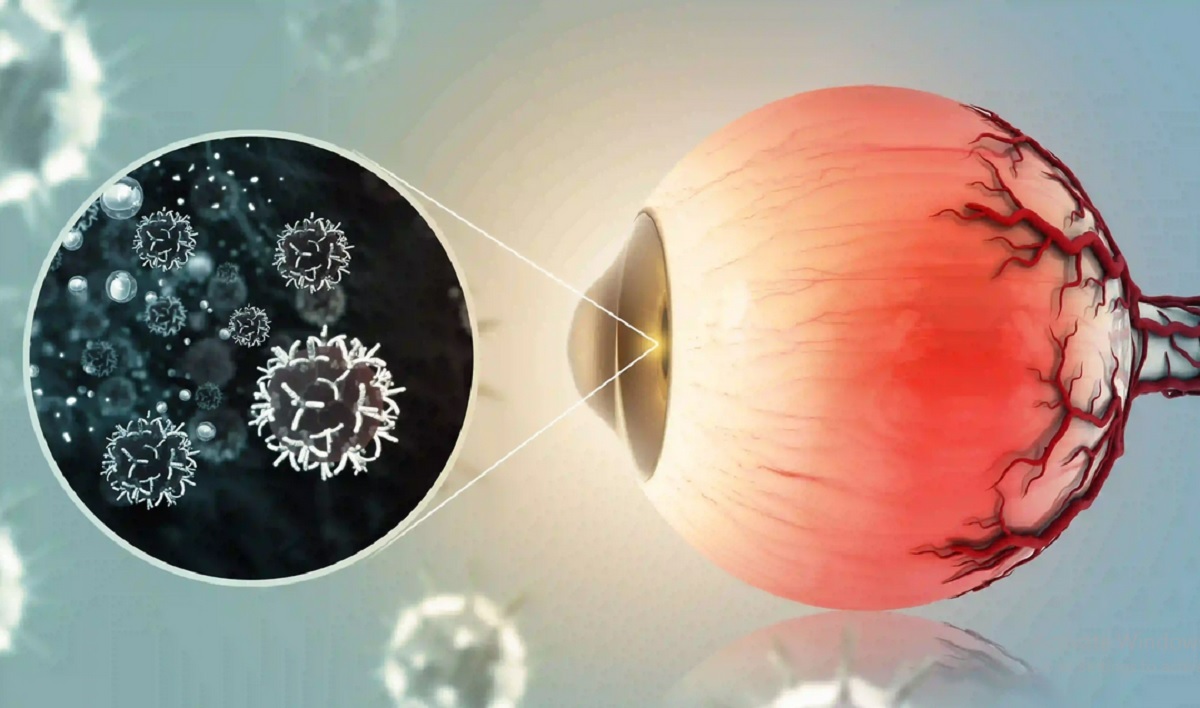 علائم ابتلا به سرطان چشم چیست؟