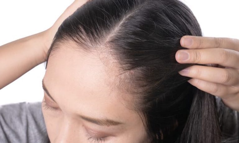 دلایل ریزش موی جلوی سر در زنان