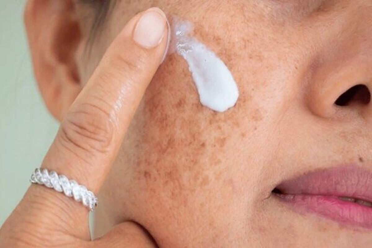 لکههای پوستی بارداری چرا ایجاد میشوند؟ لکههای پوستی بارداری چرا ایجاد میشوند؟