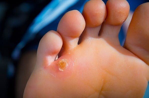 چطور از میخچه زدن پا جلوگیری کنیم؟