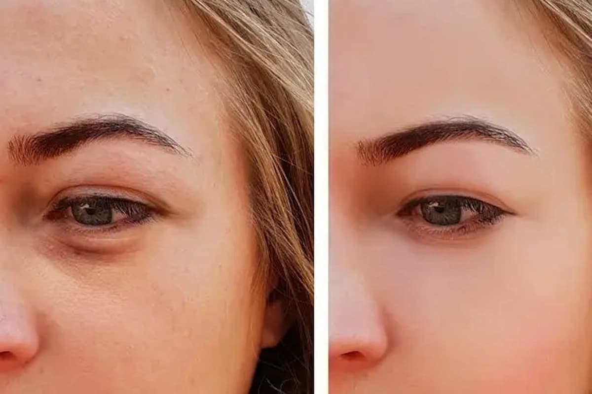 ۸ ترفند ساده و فوری برای از بین بردن پف چشم بعد از گریه ۸ ترفند ساده و فوری برای از بین بردن پف چشم بعد از گریه